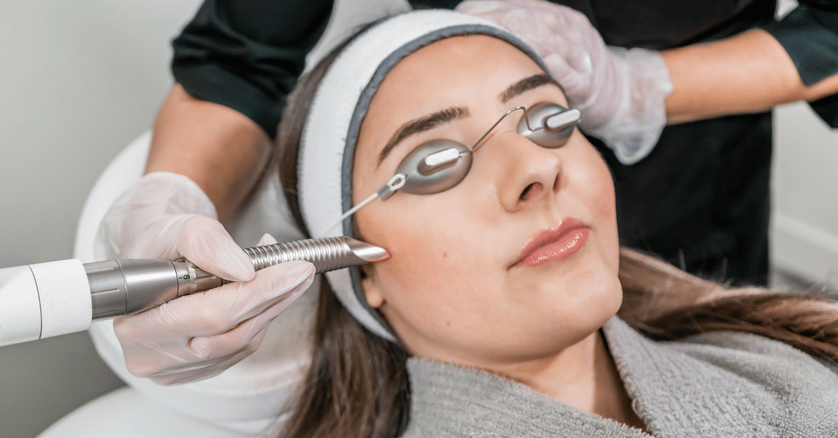 Everything about Laser Resurfacing - Expert Insights