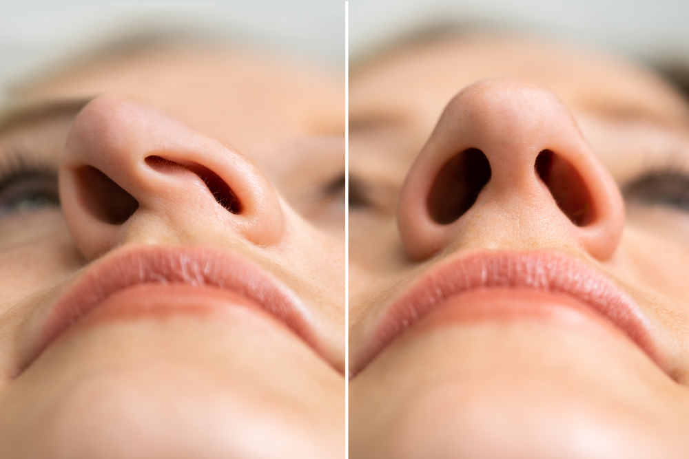 Reconstructive rhinoplasty singapore before and after